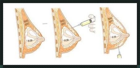药物干预，胸部丰满背后的隐忧