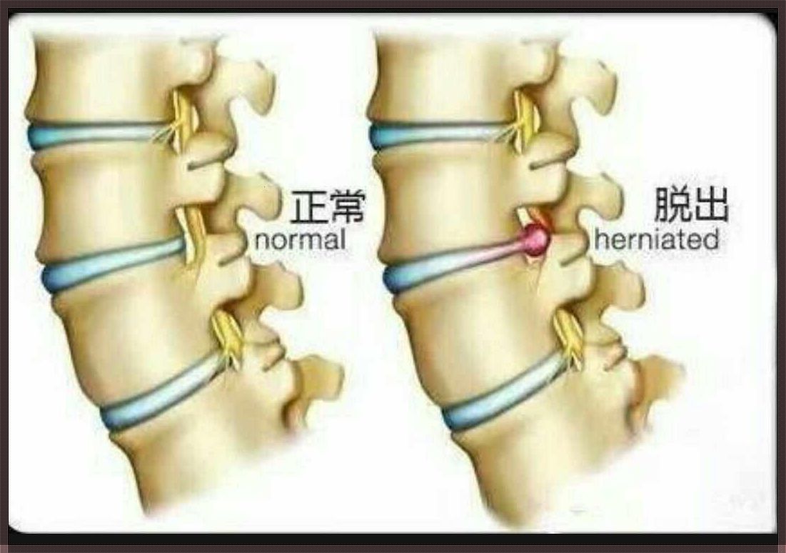 腰椎间盘突出向前突是怎么回事？揭秘腰椎健康的秘密