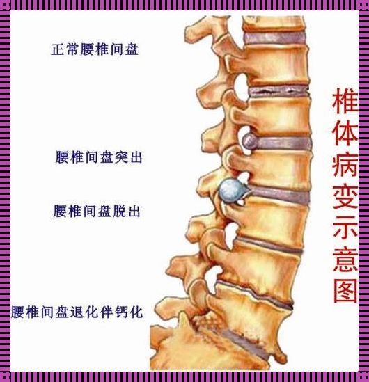 腰椎间盘突出与腰椎骨折鉴别指南