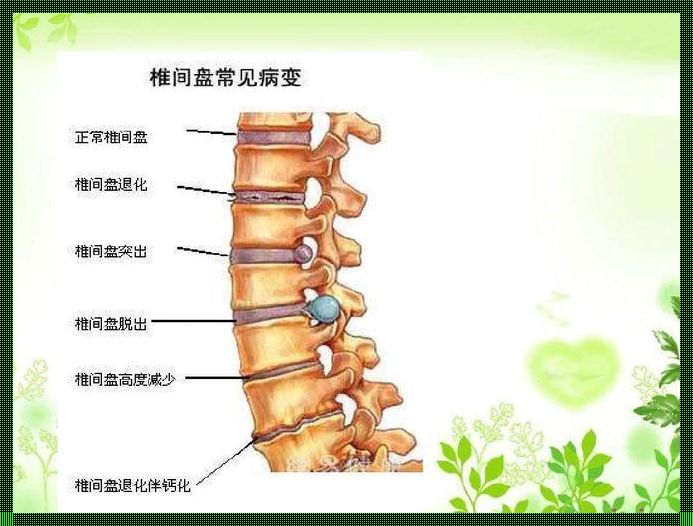 腰椎间盘突出与腰椎骨折鉴别指南