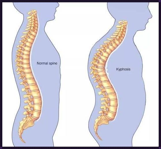 自媒体时代，男科惊现腰椎前凸现象