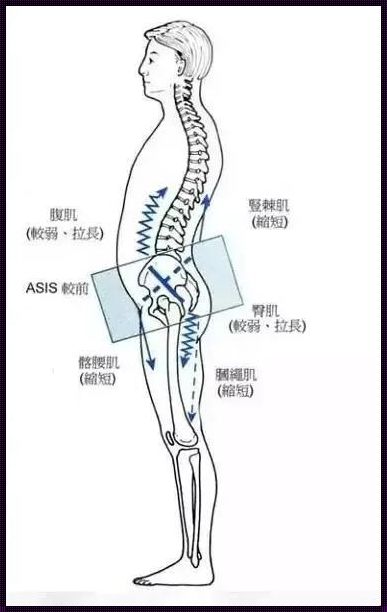 榆林惊现腰椎前倾现象，装修行业亟待关注