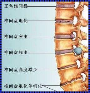 腰椎生理前凸改变之谜：病因及应对策略