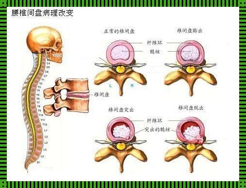 探秘椎间盘向前突出的秘密