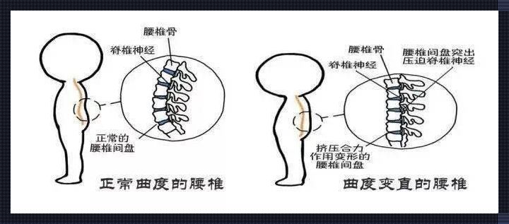 腰椎前凸之谜：科技与房产装修的奇妙联系