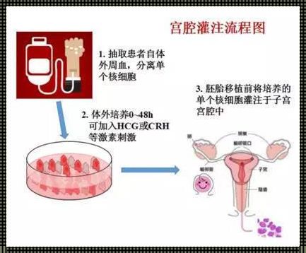 宫腔灌注揭秘：CSF治疗不孕不育新篇章