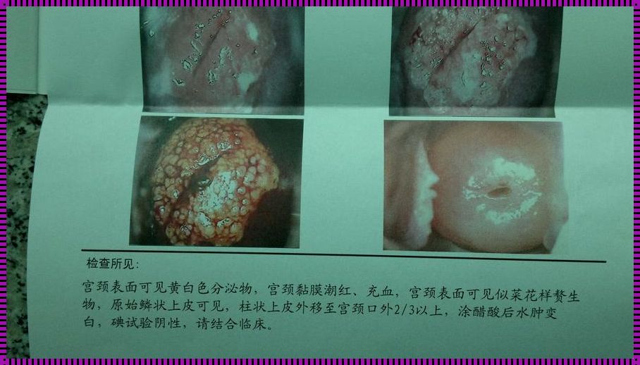 宫颈口长肉粒图片：探寻现象背后的奥秘