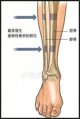 易碎之骨，脆弱之处——人体最容易骨折的三个地方