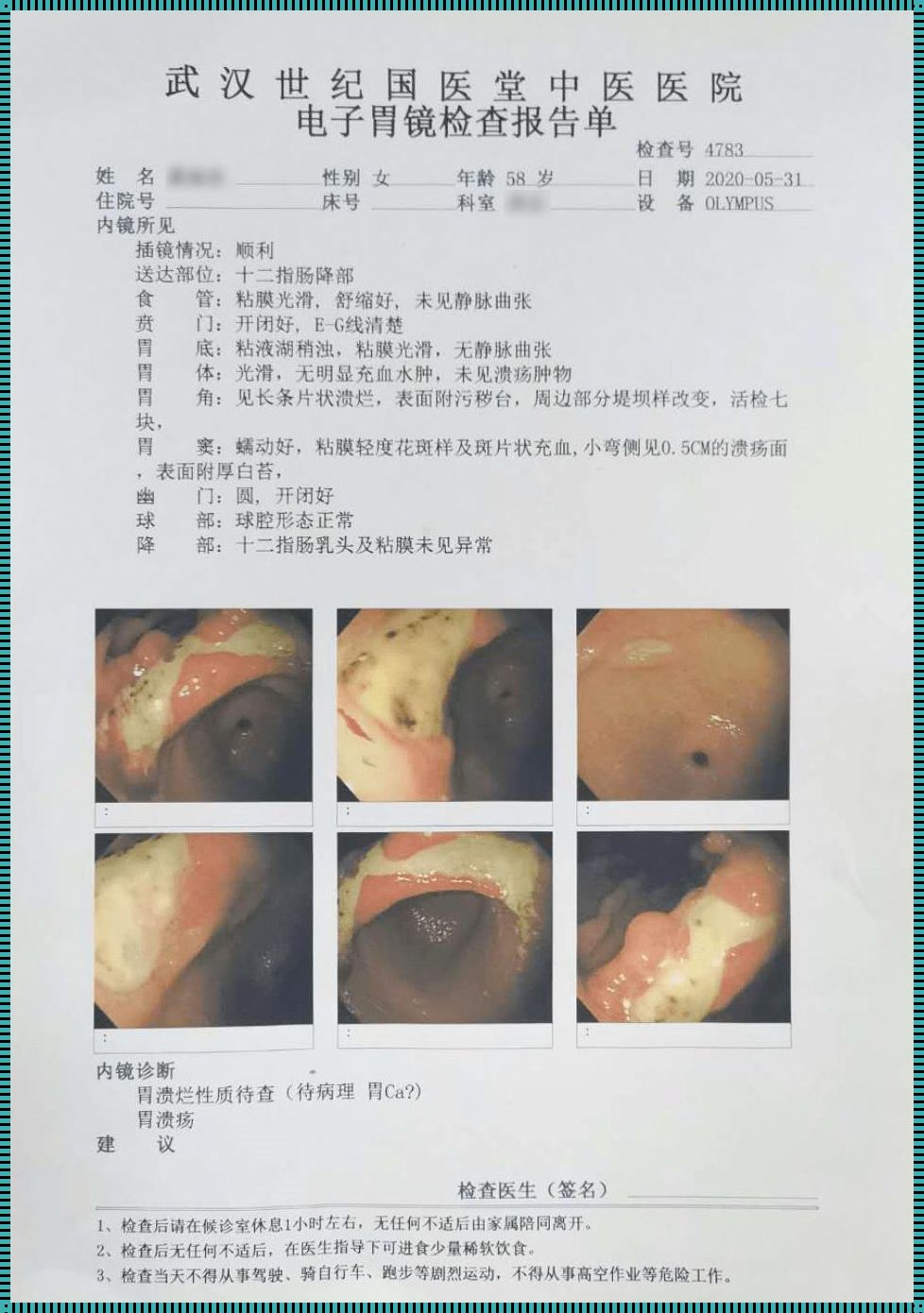 胃糜烂活检出恶性几率（胃溃疡癌变机率大吗?谢谢）