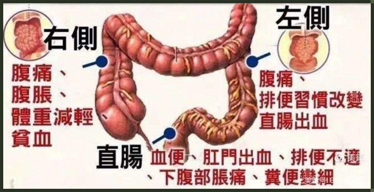 直肠癌一般有三处痛[肠癌来临的时候,“1红、2臭、3痛”是指的什么]