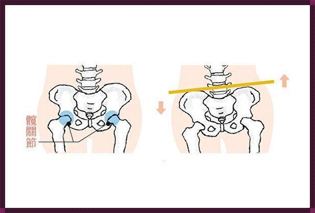 《“骨盆不正”隐秘困扰，女性朋友请注意！》